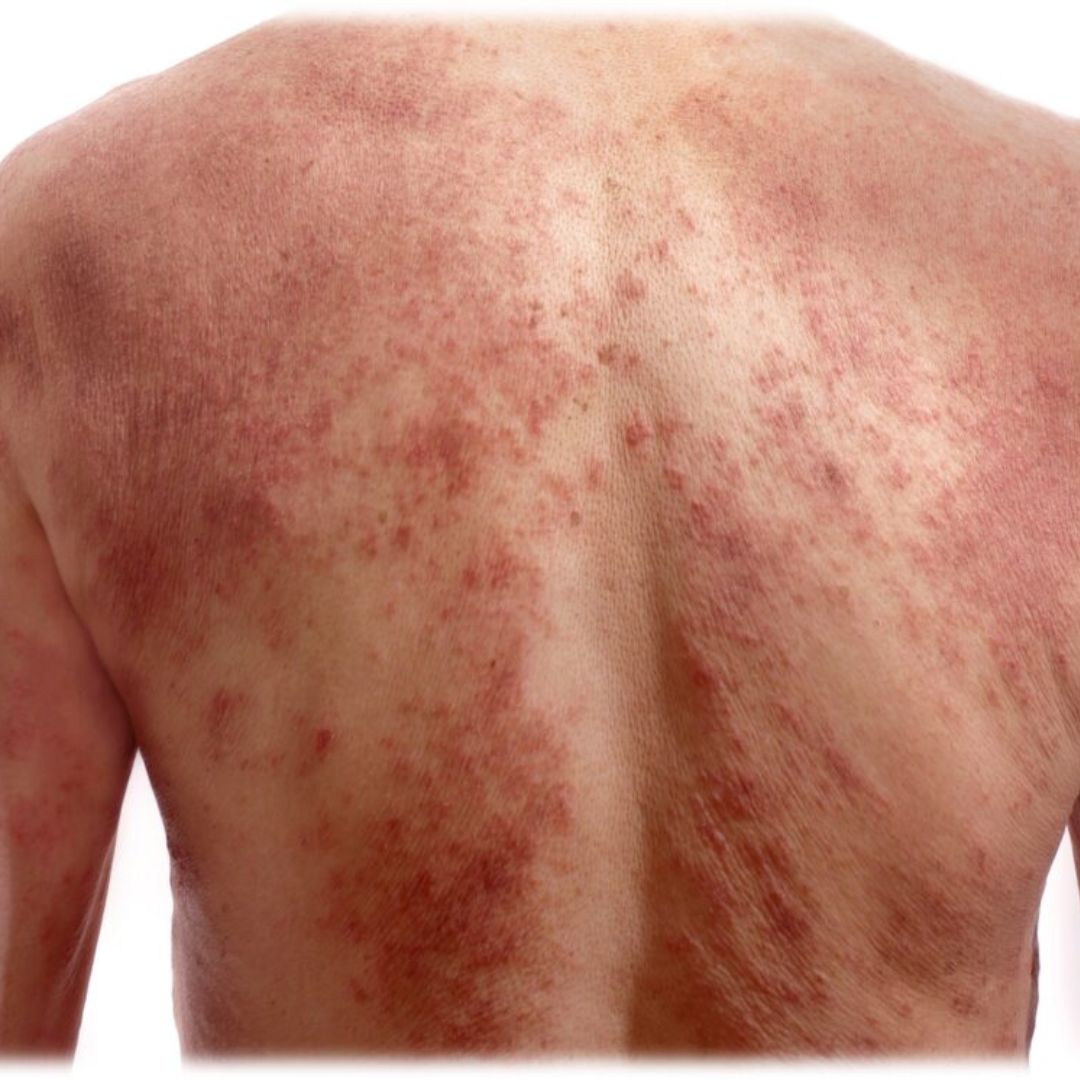 atopic dermatitis