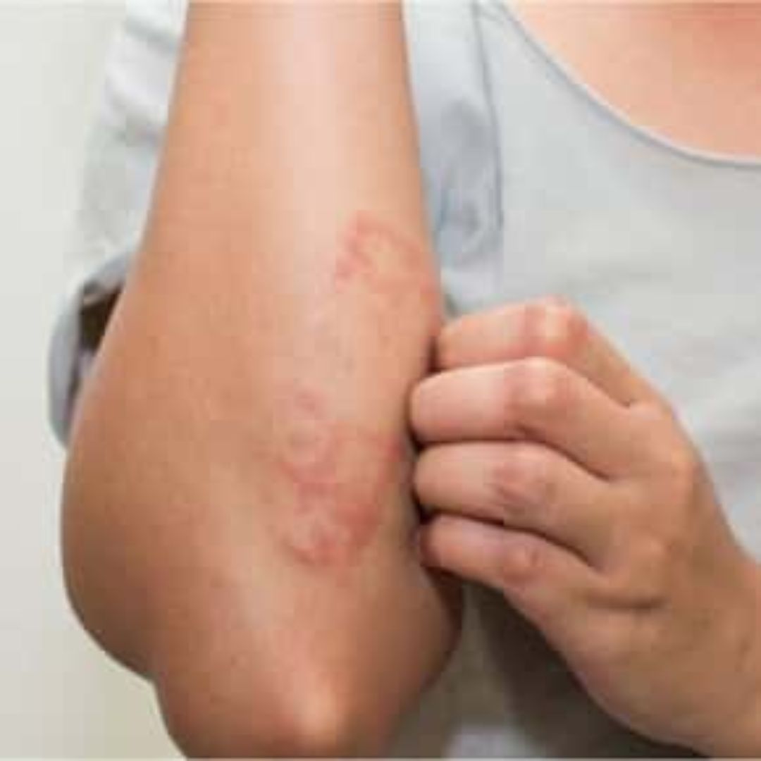 atopic dermatitis