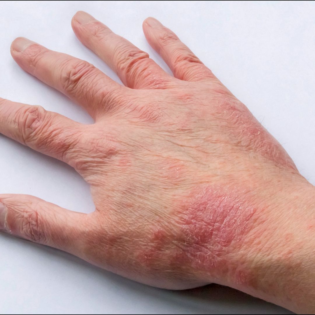 atopic dermatitis