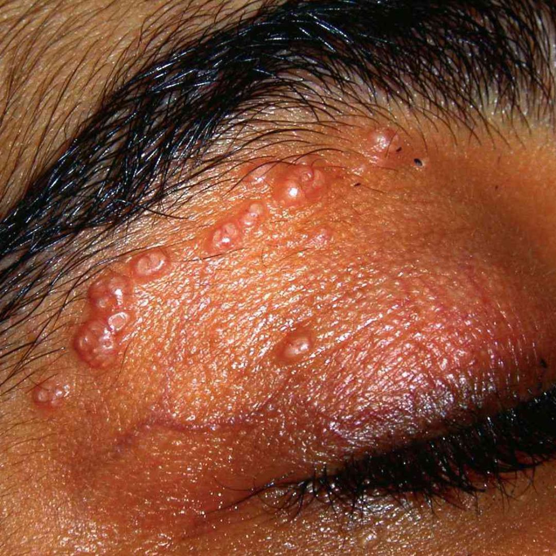 MOLLUSCUM CONTAGIOSUM