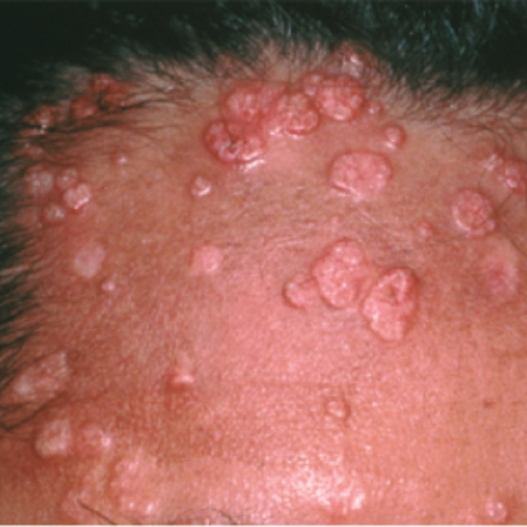 MOLLUSCUM CONTAGIOSUM