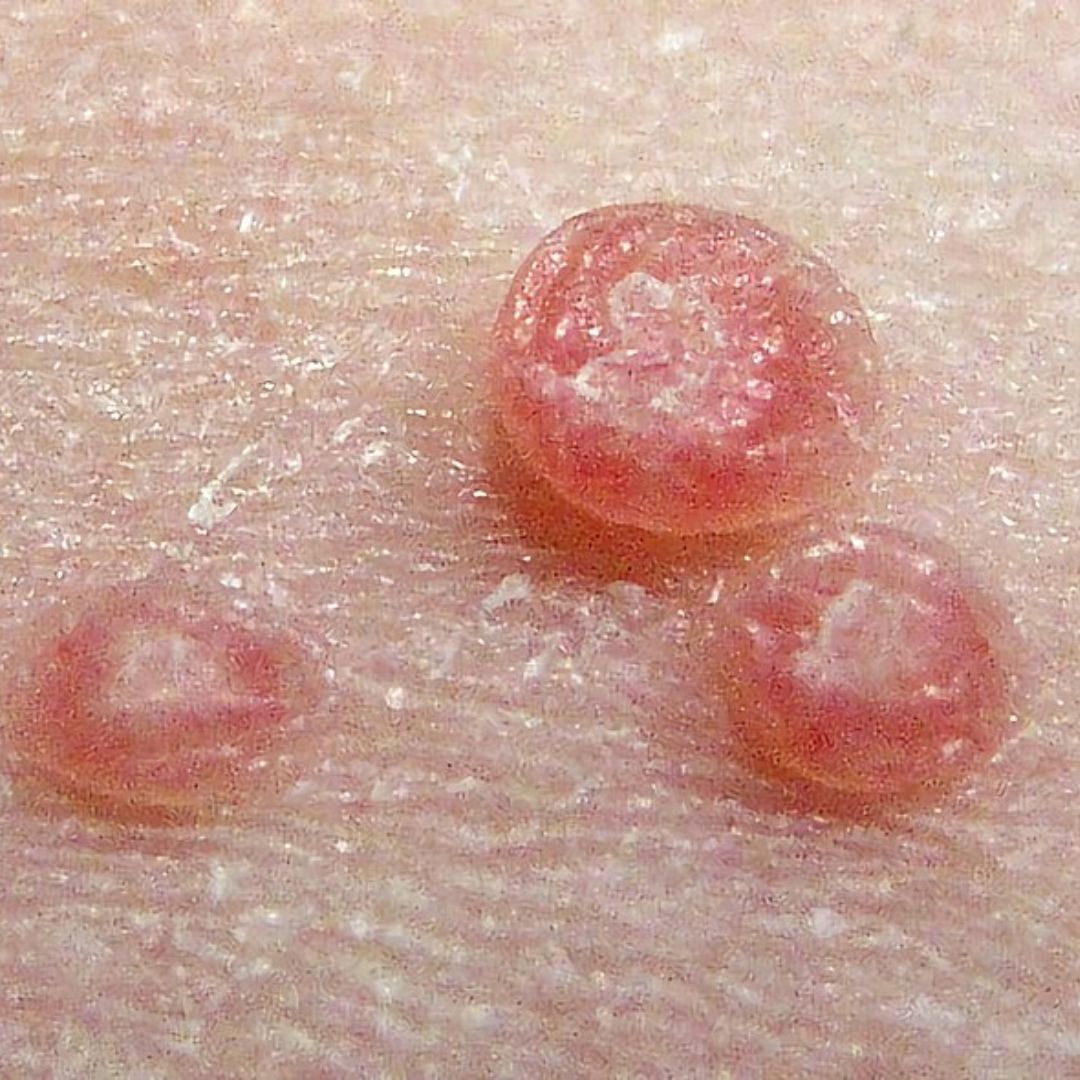 MOLLUSCUM CONTAGIOSUM