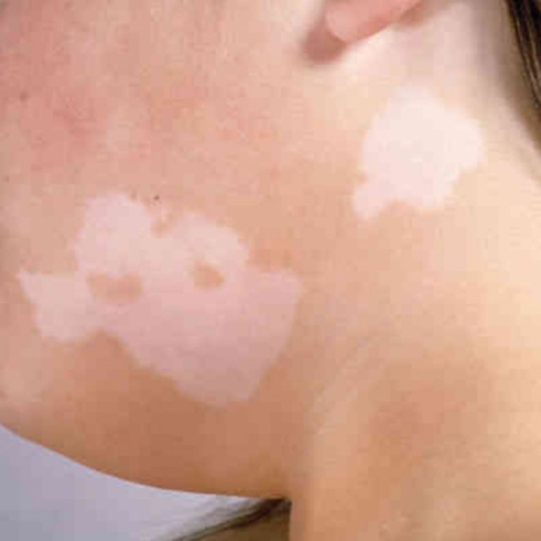 pityriasis alba