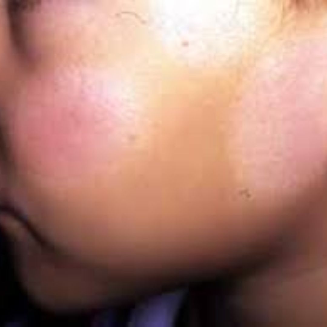 pityriasis alba