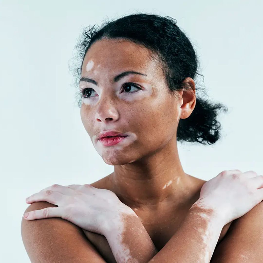 VITILIGO​