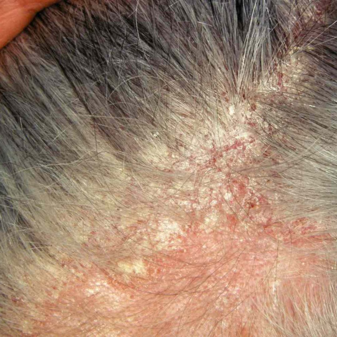 SEBORRHEIC DERMATITIS