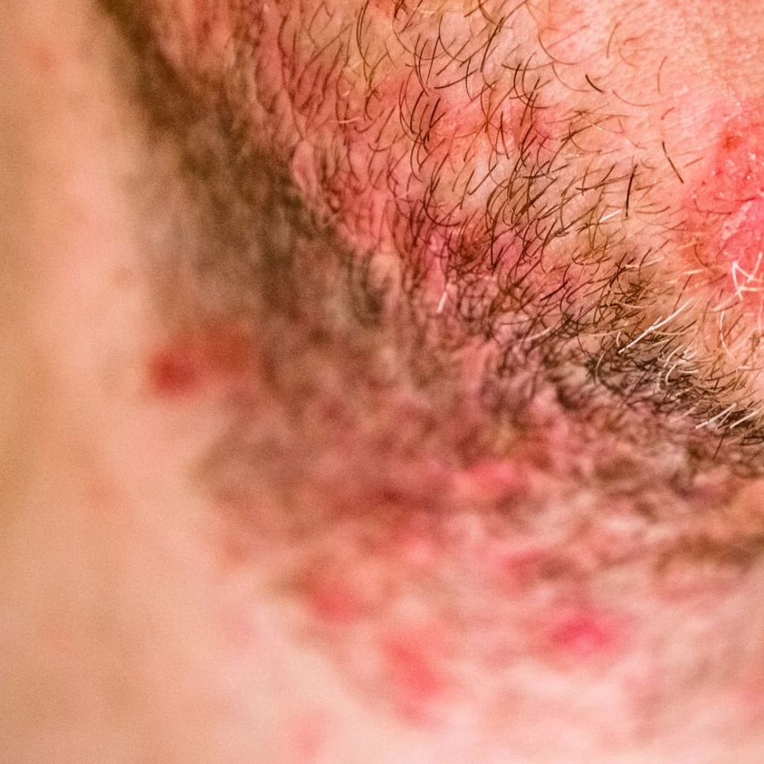 SEBORRHEIC DERMATITIS