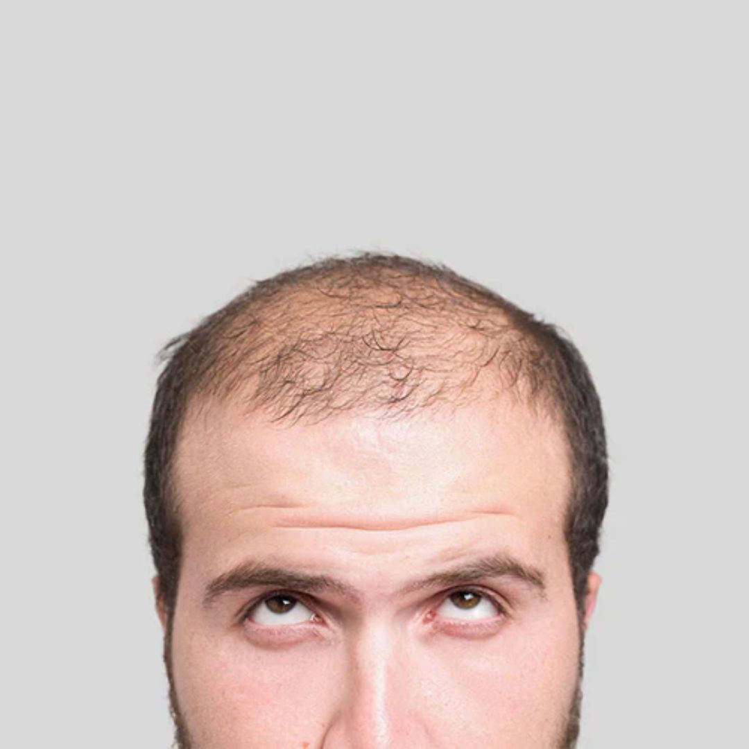 hair loss