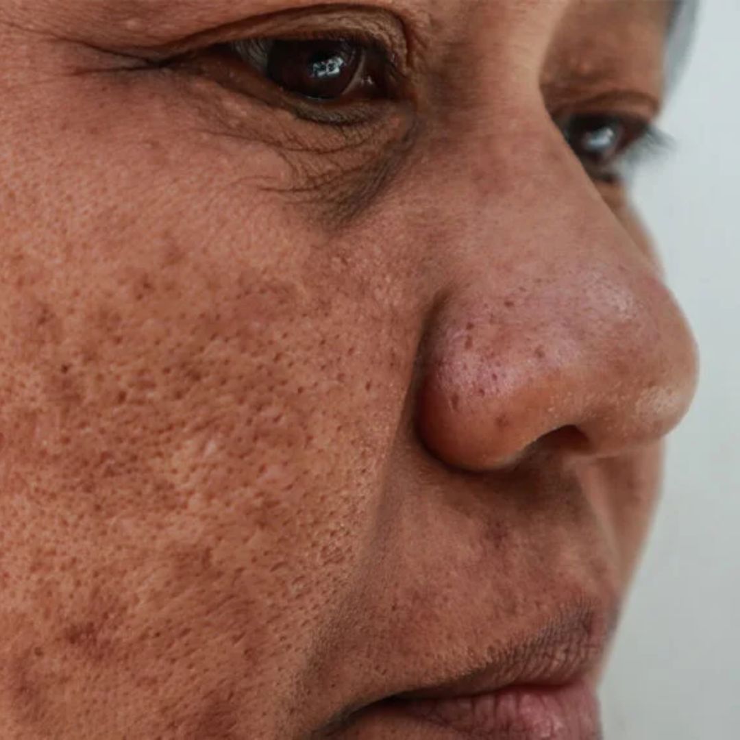 melasma