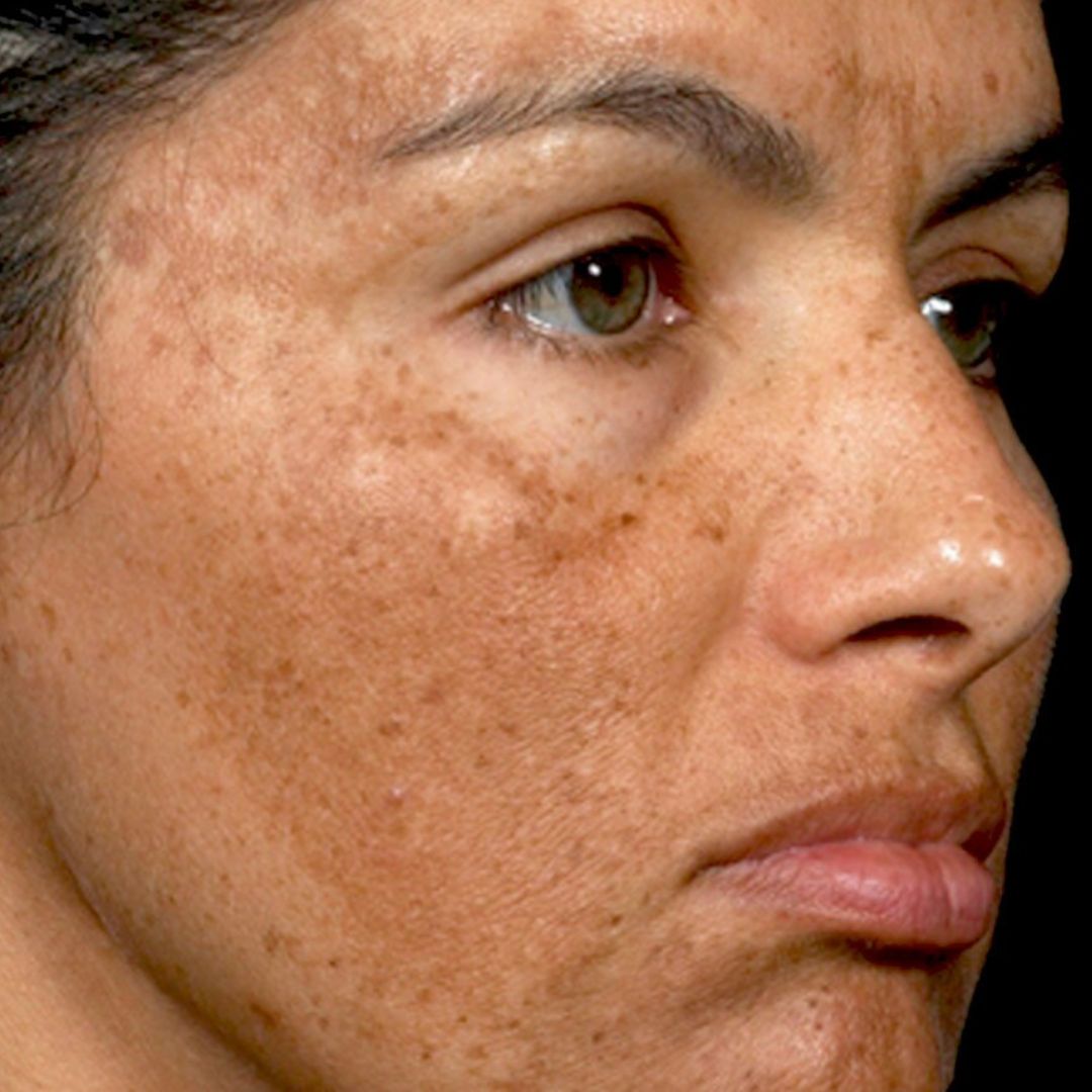 melasma