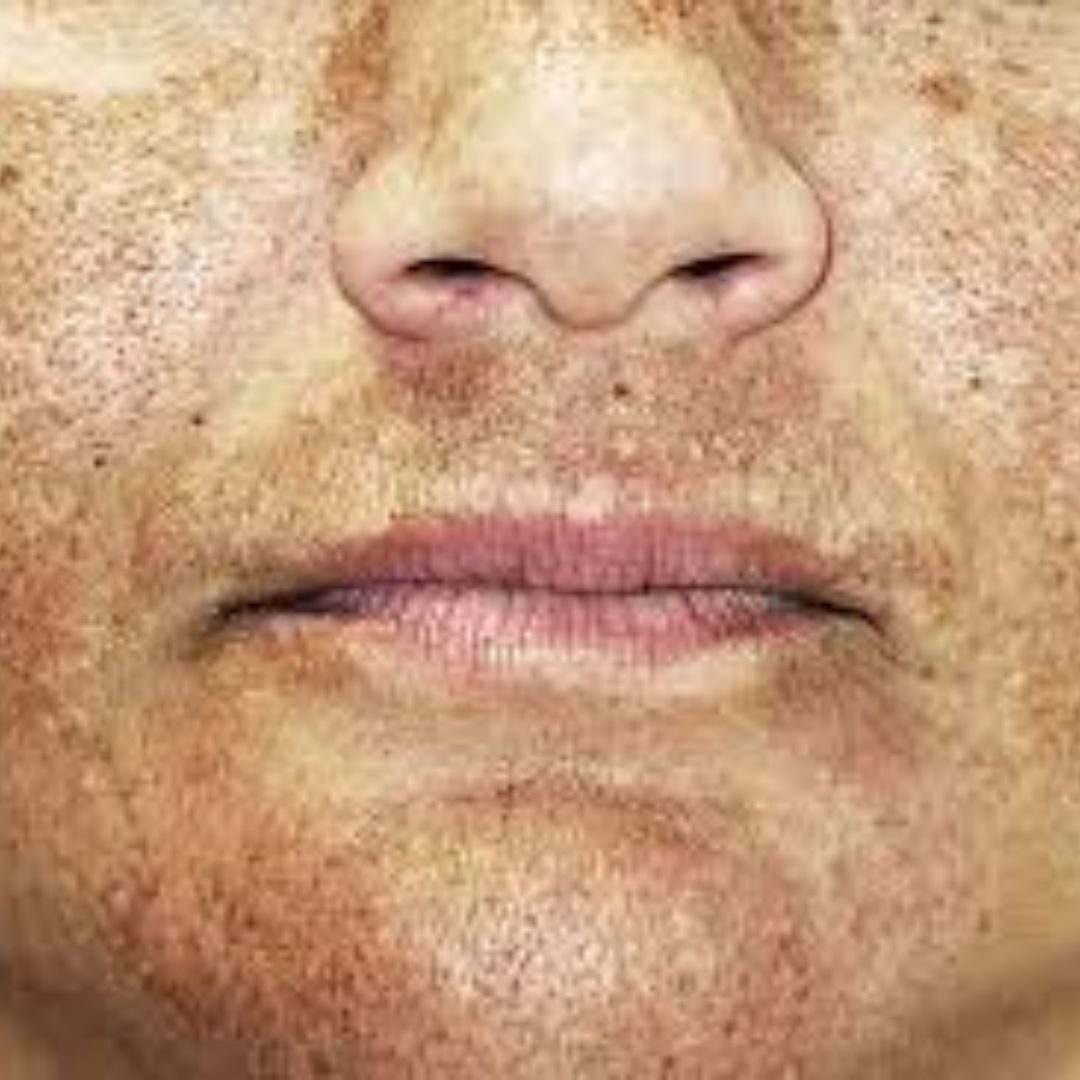 melasma