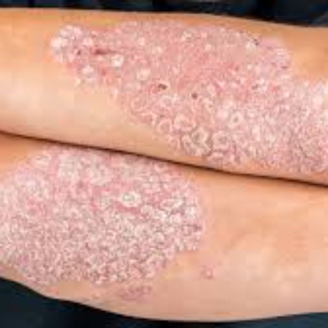 PSORIASIS