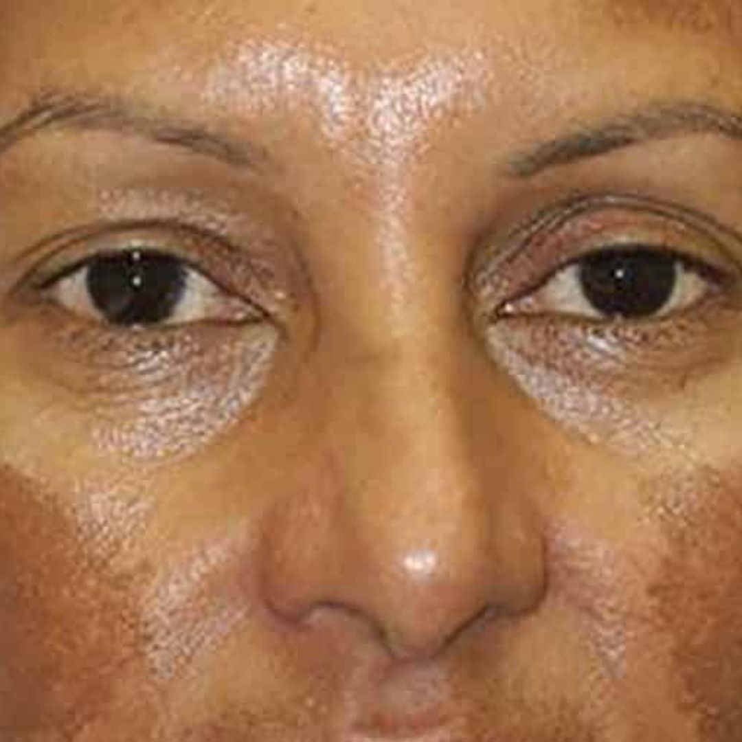 melasma