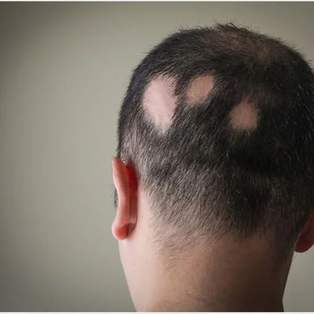 alopecia