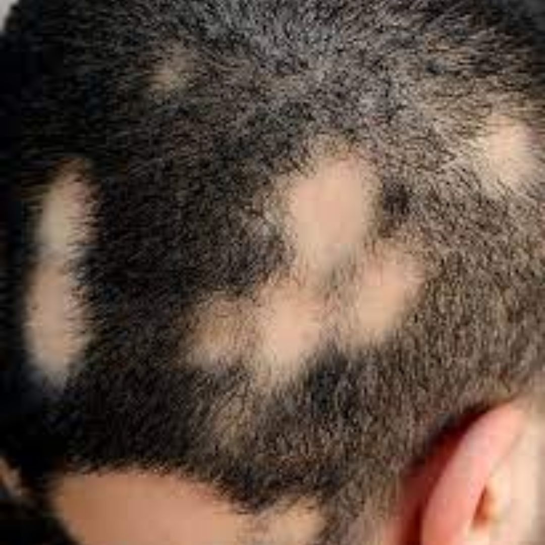 ALOPECIA