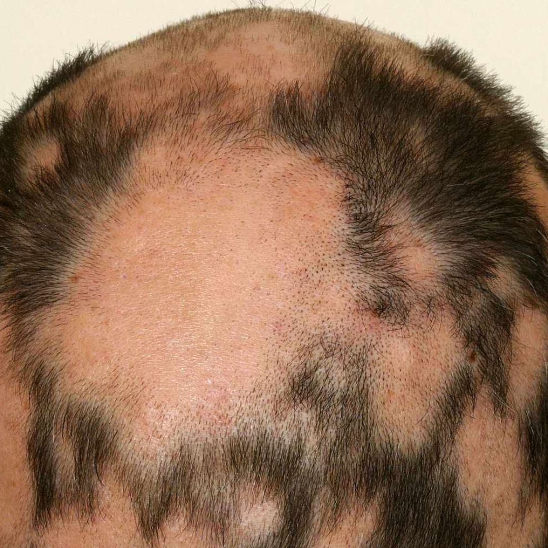 Alopecia