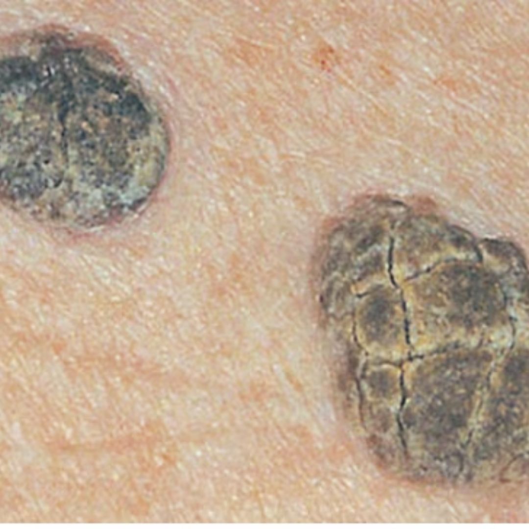 SEBORRHEIC KERATOSIS