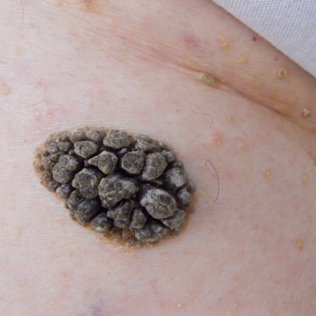 SEBORRHEIC KERATOSIS