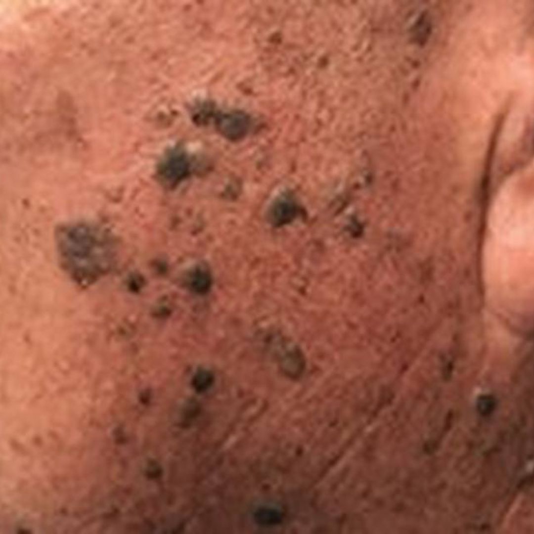 SEBORRHEIC KERATOSIS