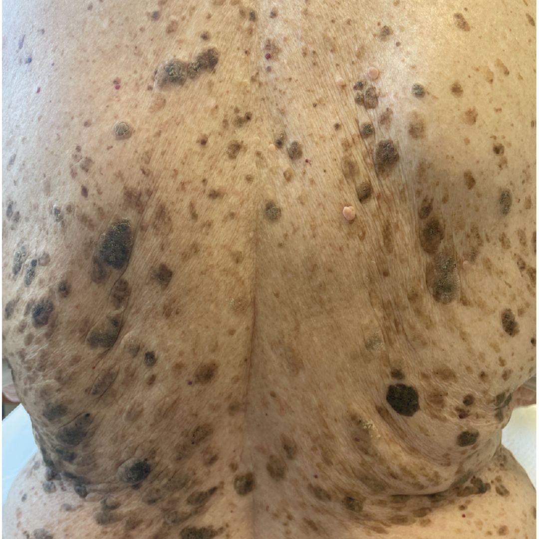 SEBORRHEIC KERATOSIS