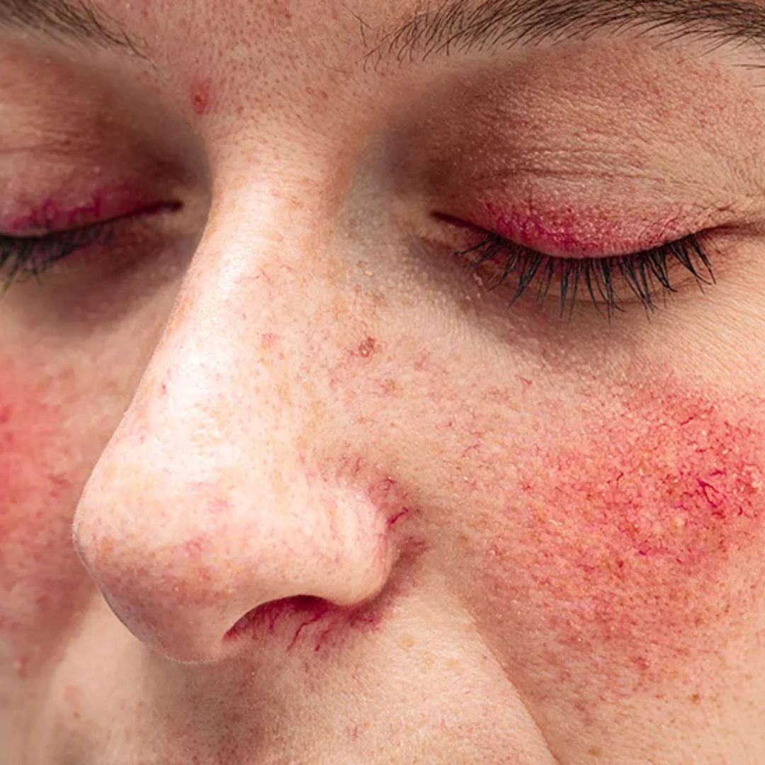 rosacea