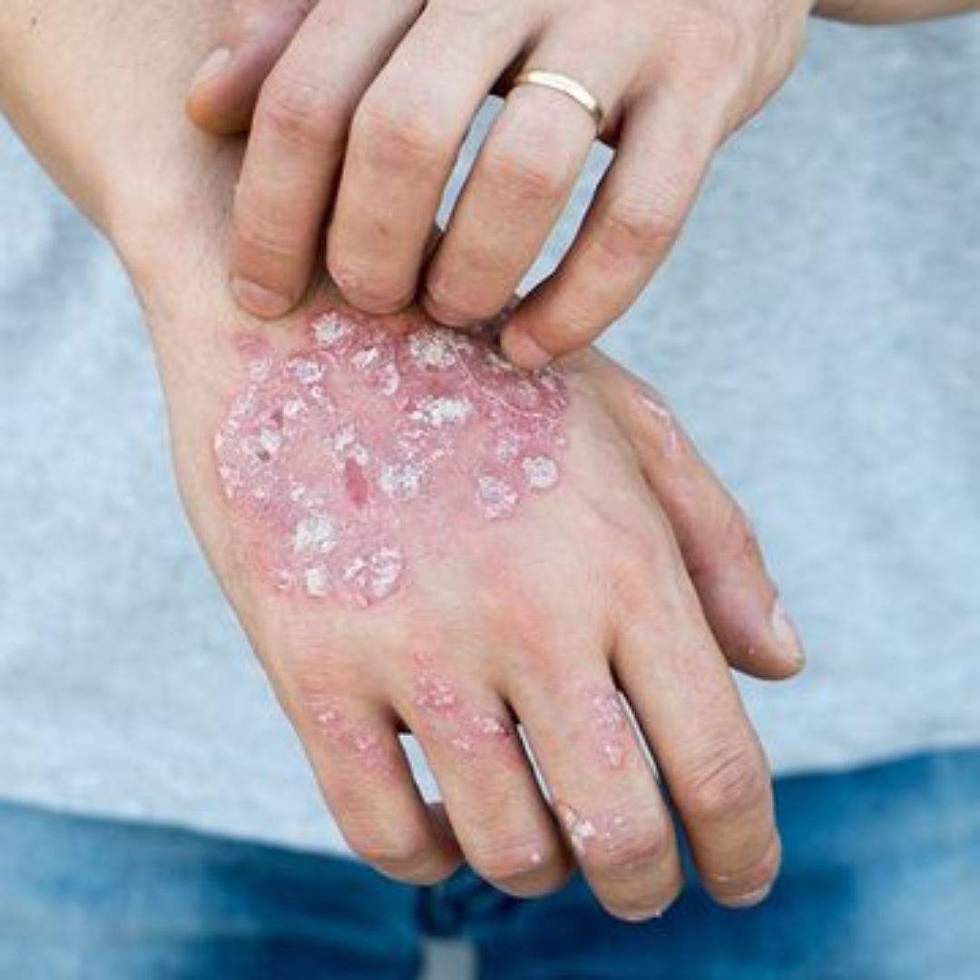 PSORIASIS