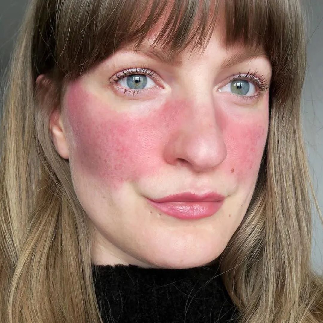 rosacea