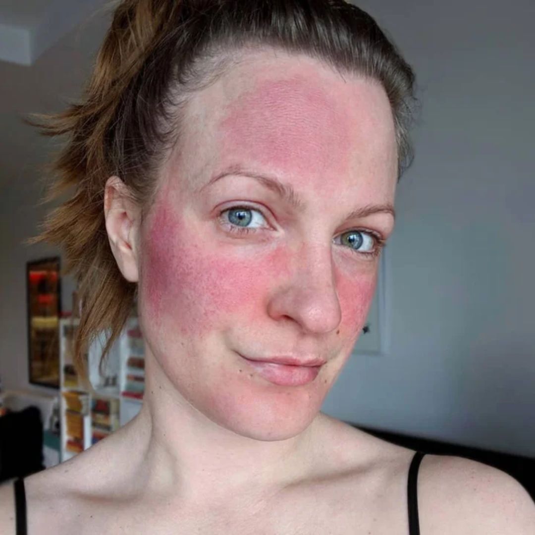 rosacea