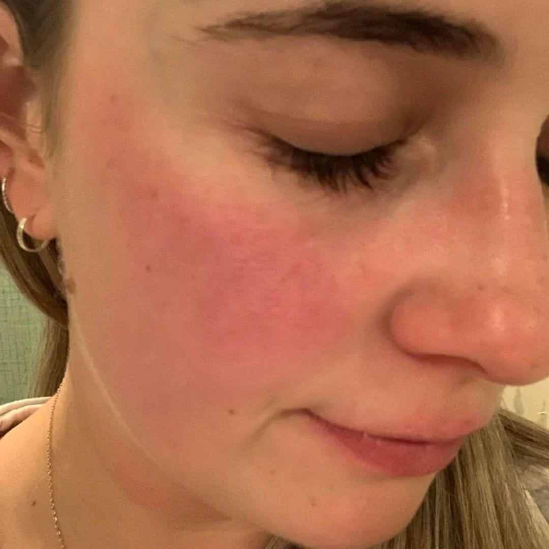 rosacea