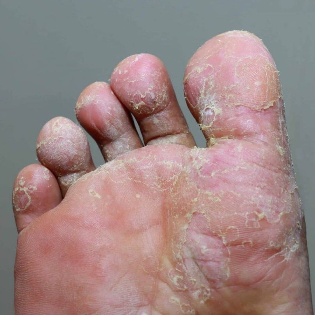 fungal infections