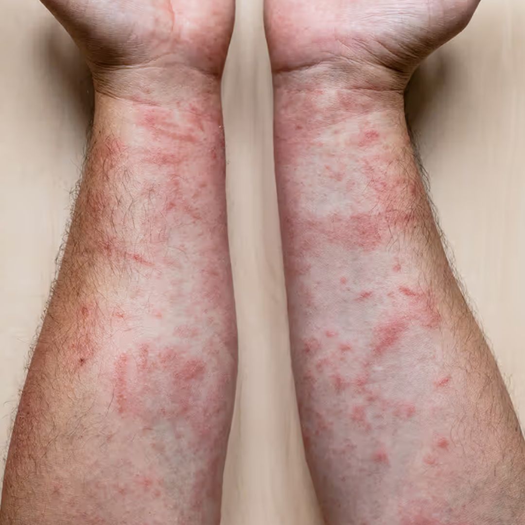 CONTACT DERMATITIS