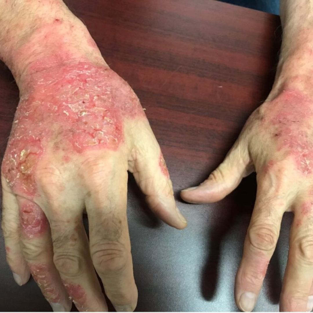 CONTACT DERMATITIS