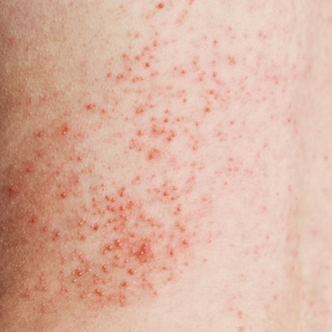 SKIN RASHES