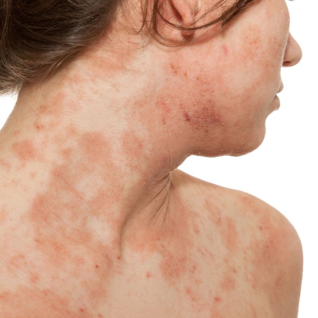 SKIN RASHES